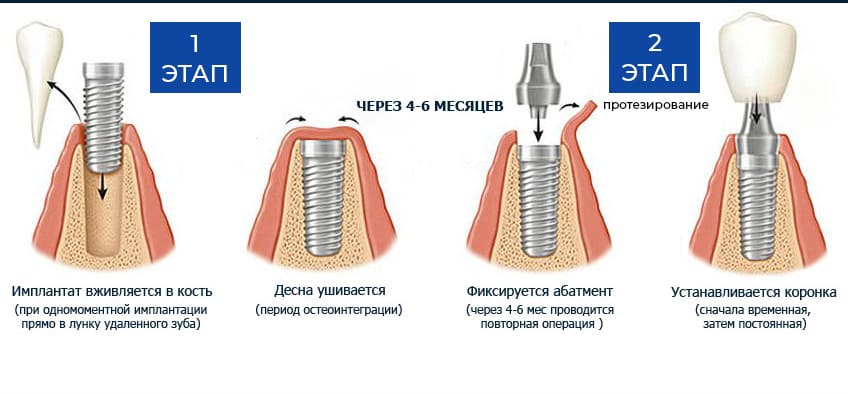 Фото Как происходит классическая имплантация