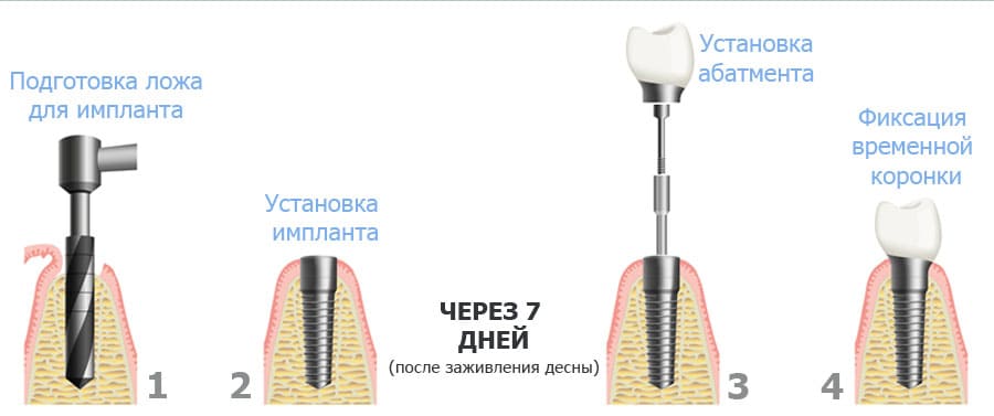 Фото Метод установки искусственной коронки