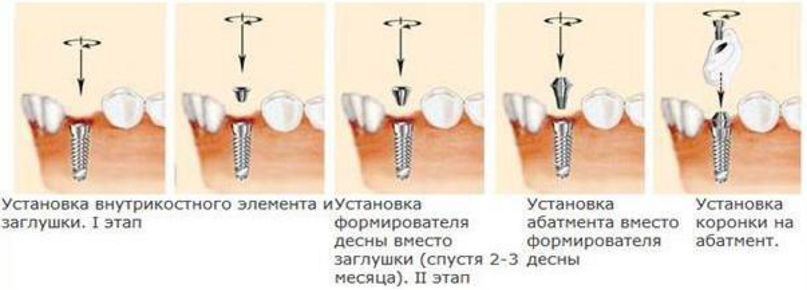 Как проходит имплантация зуба пошагово с фото Какие этапы включает в себя процедура имплантации зуба?